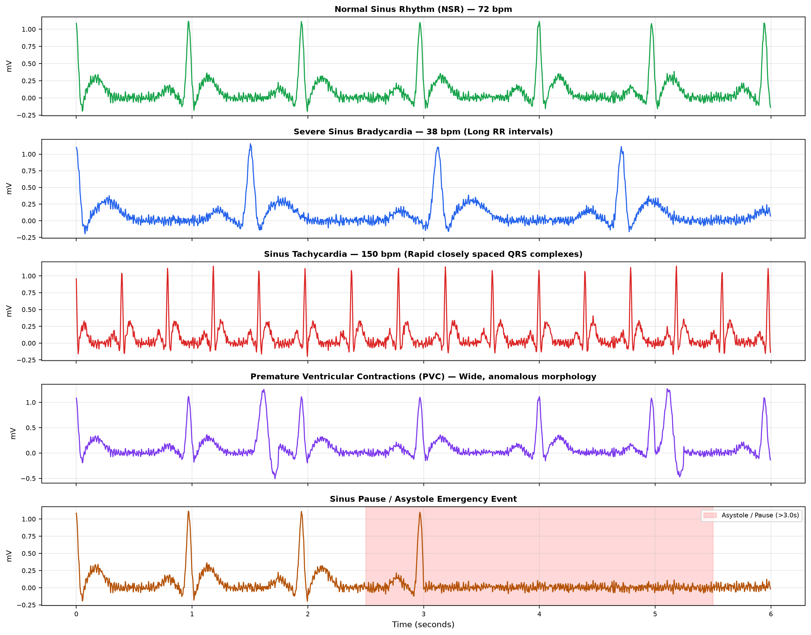 Cardiac Arrhythmias Comparison Gallery