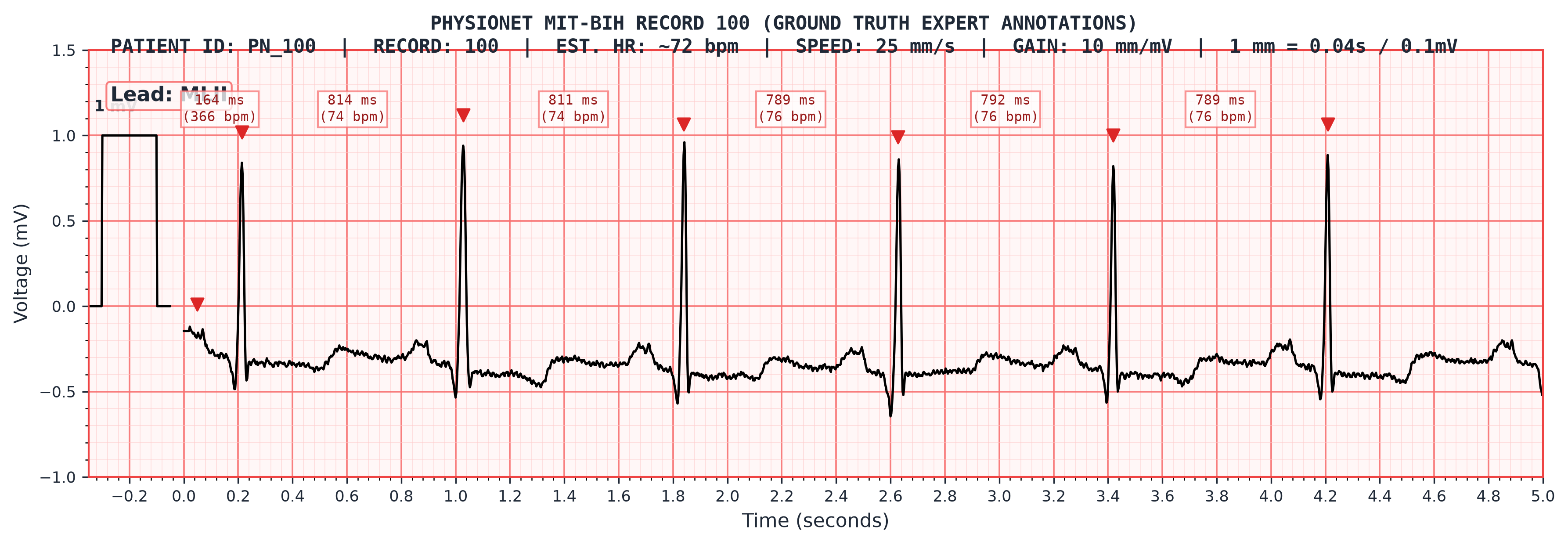 PhysioNet MIT-BIH Record 100