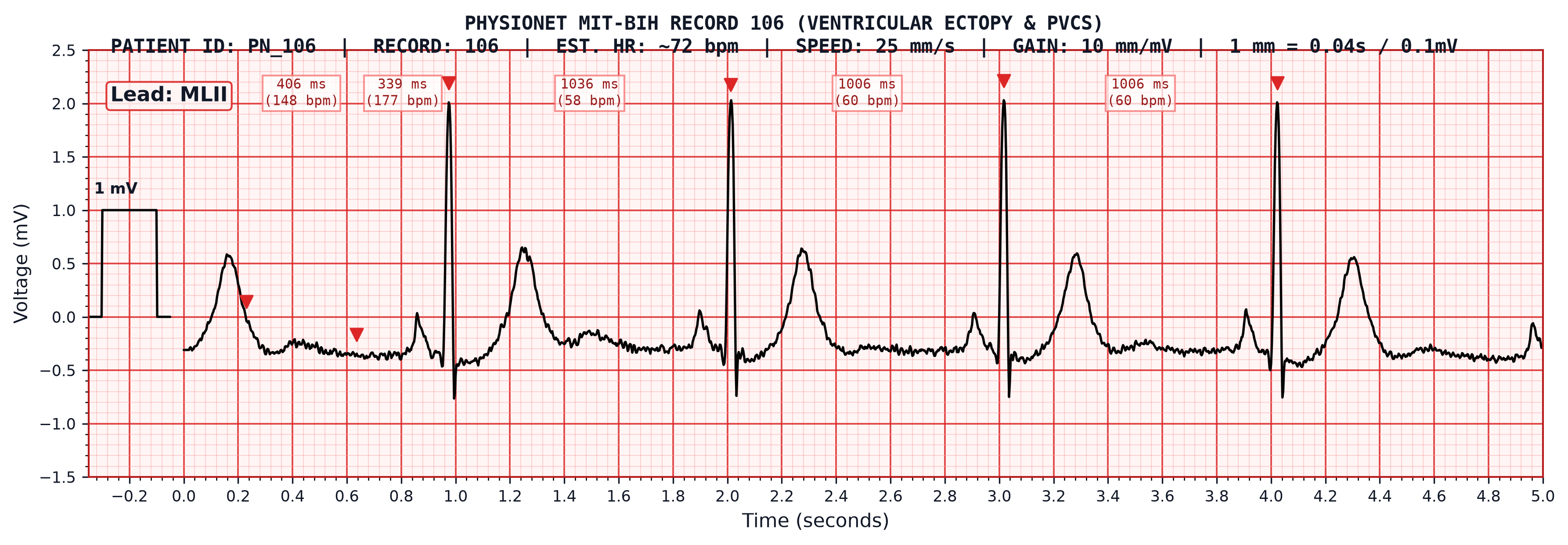 PhysioNet MIT-BIH Record 106